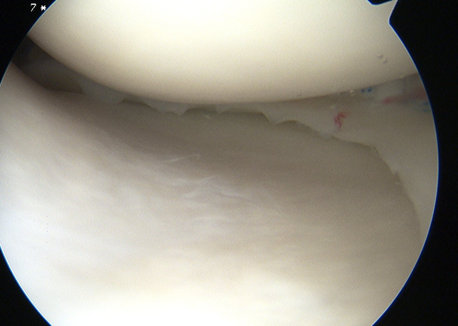 Meniscus Post Repair